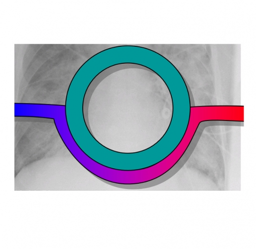 Symposium ARDS und ECMO